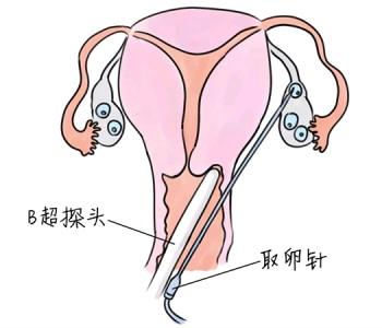 小儿退烧推拿手法 5种南京捐卵宝宝退烧按摩方法